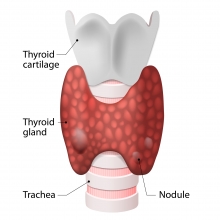 What are thyroid nodules?